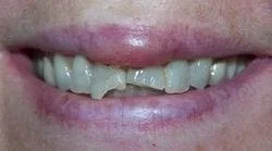 Fractured Teeth Before - Dentist in Huntsville, AL