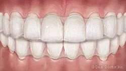 Clear Orthodontic Aligners.