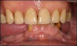 Before Deficient complete upper denture and failing dentition.