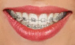 Orthodontic Treatment (Braces) - Plover, WI Dentist | Plover Family Dental Care