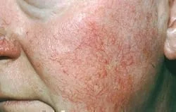 rosacea-symptoms_ETR.jpg