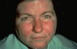 rosacea-symptoms_acne.jpg