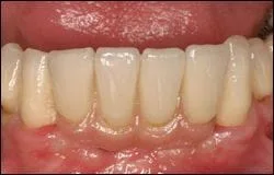 After  Implant bridge supported by two implants with pink porcelain to mimic missing gum tissue.