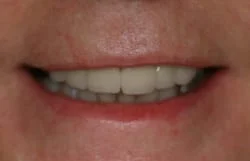 final result of woman's smile makeover, showing nice teeth after partial dentures and teeth whitening Cumberland Park SA dentist