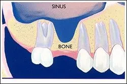 Sinus Lift