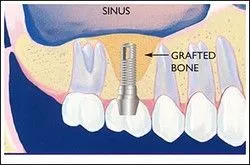 Sinus Lift