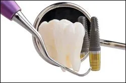 Dental Implants erie pa