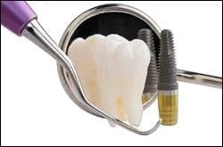 Dental Implants Encino CA