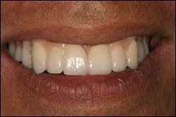 Before Patient missing all upper teeth wearing a denture.