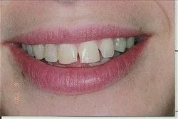image of teeth gapped and misshapen, before veneers Roslyn, NY