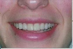 image of straight, nice teeth no gaps, after veneers Roslyn, NY