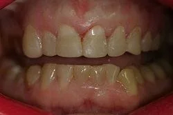 patient's mouth, close up showing teeth after smile makeover with cosmetic fillings Cumberland Park, SA dentist