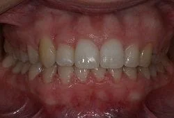 Hidden cheaper braces straightening teeth quickly