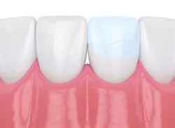 illustration of row of teeth, bonding on one tooth repairing crack, dental bonding Decatur, IL dentist