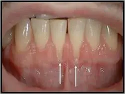 Gum Graft