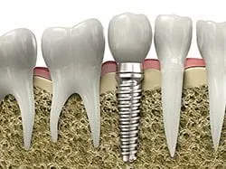 dental implants Selmer, TN
