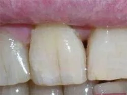 cracked tooth, Mahwah, NJ dentist