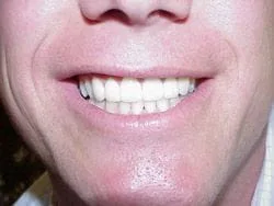 man's smiling mouth showing teeth after veneers Downtown San Diego, CA