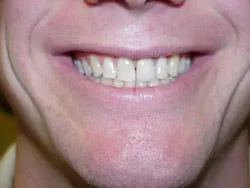 man smiling showing teeth before porcelain veneers Downtown San Diego, CA dentist