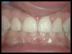 Gingivoplasty_F Neal Pylant Athens GA_Periodontics_Dental Implants