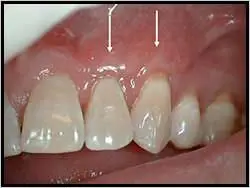 gum Graft