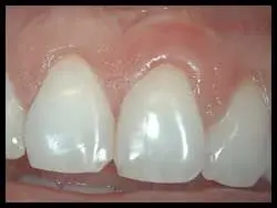 Semilunar Grafts_F Neal Pylant Athens GA_Periodontics_Dental Implants