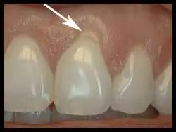 Semilunar Grafts_F Neal Pylant Athens GA_Periodontics_Dental Implants