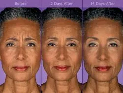 Botox in Chevy Chase, MD