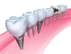 Illustration of a dental implant