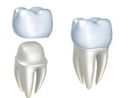 Dental Crowns thumbnail