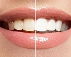teethn whitening
