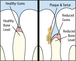 periodontitis.gif