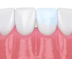 illustration of row of teeth, one tooth with dental bonding repairing crack, dentist Encinitas, CA cosmetic dentistry