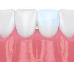 illustration of three teeth, one tooth with dental bonding repairing crack, tooth bonding Harrisburg, PA dentist