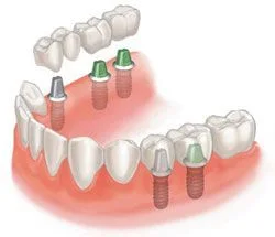 dentalimplants2.jpg