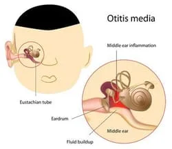 Thousand Oaks, Simi Valley, Oxnard, & Camarillo Ear Infections