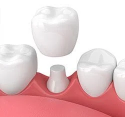 3D computer illustration of dental crown being placed over tooth, dental crowns Katonah, NY dentist