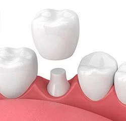 3D computer illustration of dental crown being placed over tooth in mouth, dental crowns Philadelphia, PA