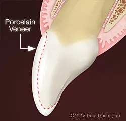 Morris dental veneers