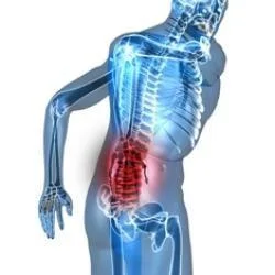 Model of someone suffering from severe back pain 
