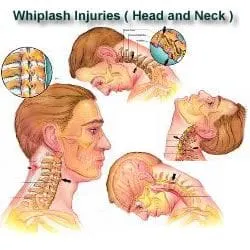 Whiplash injuries to the head and neck