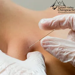 Dry Needling Bozeman Montana