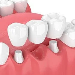 3D computer illustration of dental bridge with three crowns being placed over abutment teeth, dental bridge Katonah, NY dentist