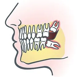 wisdomteeth