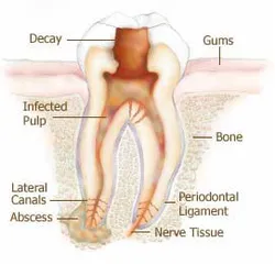 Root canal Lehi, UT