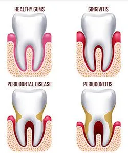 gumdisease