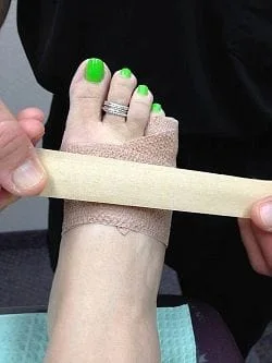 5th Toe Fracture Splinting Technique