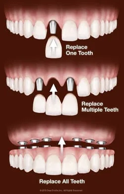 Dental Implant Treatment 