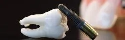 Dental Implants thumbnail