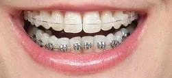 Clear teenager braces